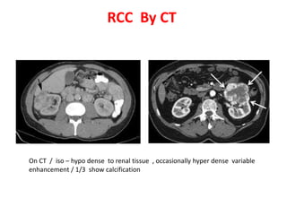 RCC By CT 
On CT / iso – hypo dense to renal tissue , occasionally hyper dense variable 
enhancement / 1/3 show calcification 
 