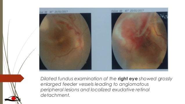 eye test old 6 year Von disease lindau hippel eye test old 6 year Von disease lindau hippel