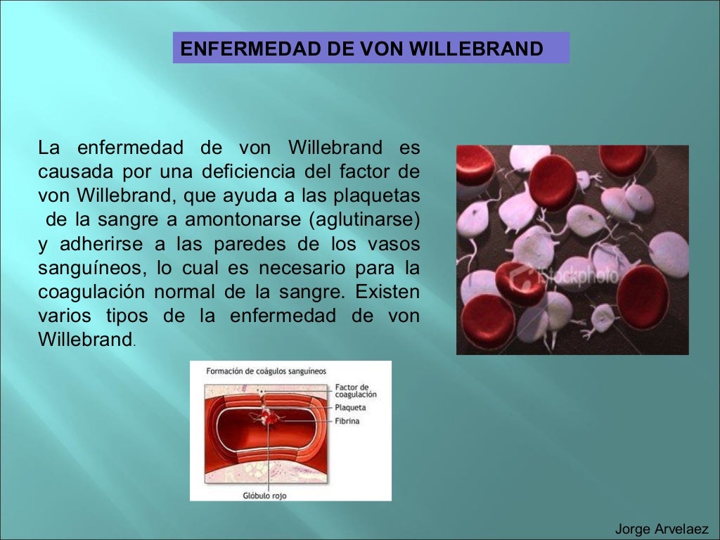 Enfermedad de Von willerbrand