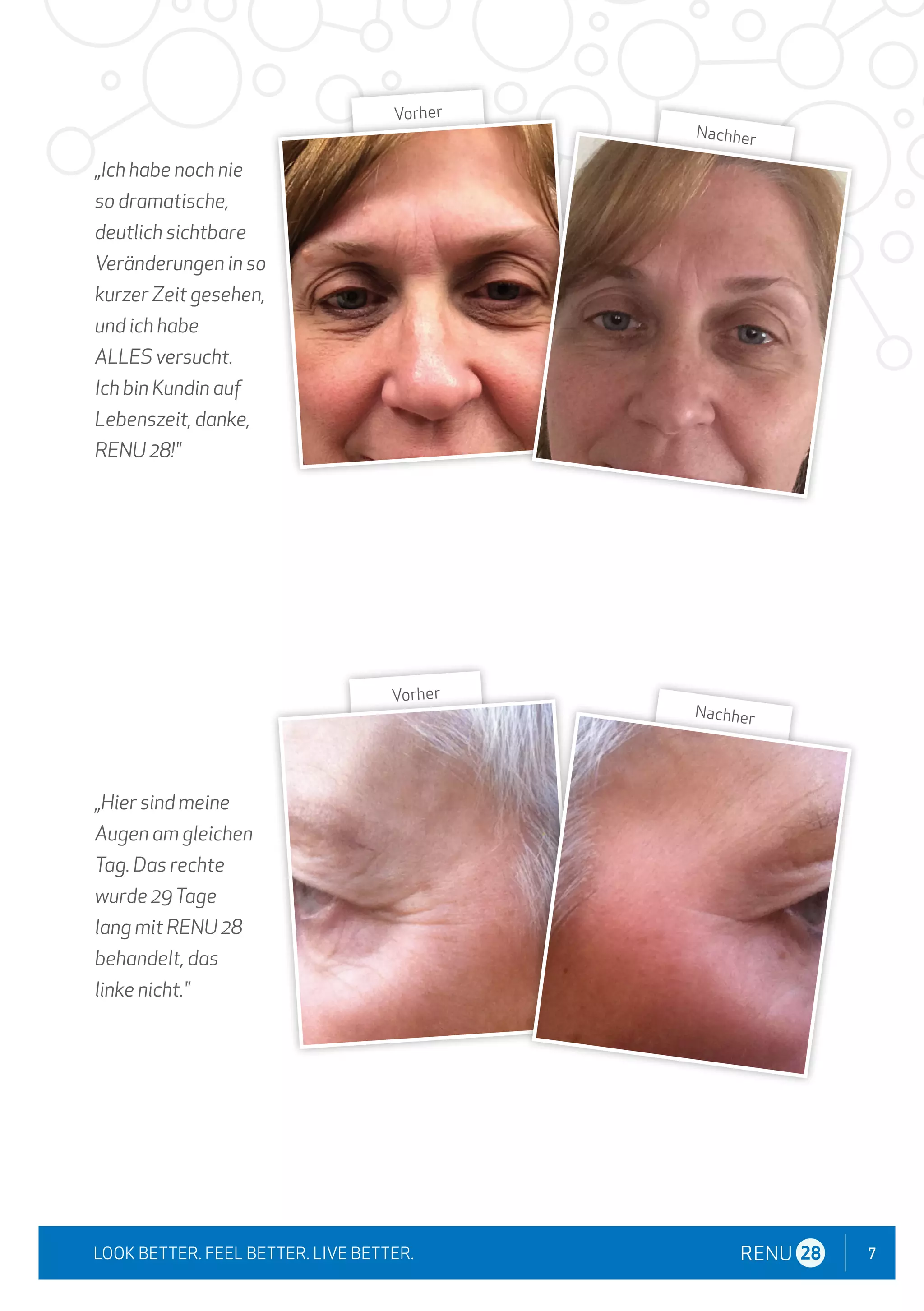 7
LOOK BETTER. FEEL BETTER. LIVE BETTER.
„Ich habe noch nie
so dramatische,
deutlich sichtbare
Veränderungen in so
kurzer Zeit gesehen,
und ich habe
ALLES versucht.
Ich bin Kundin auf
Lebenszeit, danke,
RENU 28!"
„Hier sind meine
Augen am gleichen
Tag. Das rechte
wurde 29Tage
lang mit RENU 28
behandelt, das
linke nicht."
Vorher
Nachher
Vorher
Nachher
 