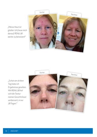 10 ASEA.NET
„Meine Haut ist
glatter. Ich freue mich
darauf, RENU 28
weiter zu benutzen!"
„Schon am dritten
Tag habe ich
Ergebnisse gesehen.
Mit RENU 28 hat
sich dieTextur
meinerGesichtshaut
verbessert, in nur
28Tagen."
Vorher
Nachher
Vorher
Nachher
 