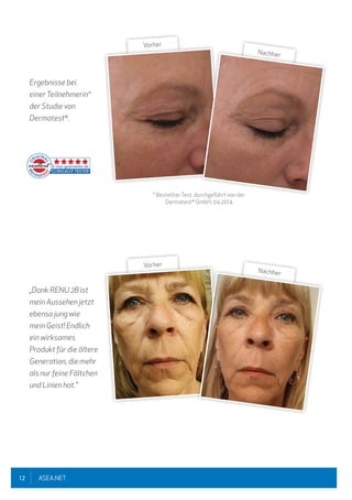 12 ASEA.NET
Ergebnisse bei
einerTeilnehmerin*
der Studie von
Dermatest®
.
„Dank RENU 28 ist
mein Aussehen jetzt
ebenso jung wie
mein Geist! Endlich
ein wirksames
Produkt für die ältere
Generation, die mehr
als nur feine Fältchen
und Linien hat."
* BestellterTest, durchgeführt von der
Dermatest®
GmbH, 04.2014
Vorher
Nachher
Vorher
Nachher
 