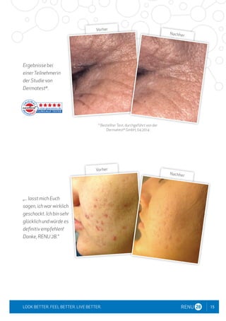 15
LOOK BETTER. FEEL BETTER. LIVE BETTER.
Ergebnisse bei
einerTeilnehmerin
der Studie von
Dermatest®
.
„... lasst mich Euch
sagen, ich war wirklich
geschockt. Ich bin sehr
glücklich und würde es
definitiv empfehlen!
Danke, RENU 28."
* BestellterTest, durchgeführt von der
Dermatest®
GmbH, 04.2014
Vorher
Nachher
Vorher
Nachher
 