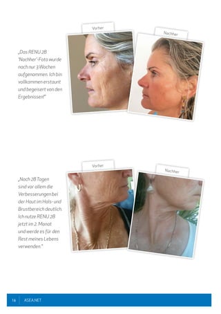16 ASEA.NET
„Das RENU 28
'Nachher'-Foto wurde
nach nur 3 Wochen
aufgenommen. Ich bin
vollkommen erstaunt
und begeisert von den
Ergebnissen!"
„Nach 28Tagen
sind vor allem die
Verbesserungen bei
der Haut im Hals- und
Brustbereich deutlich.
Ich nutze RENU 28
jetzt im 2. Monat
und werde es für den
Rest meines Lebens
verwenden."
Vorher
Nachher
Vorher
Nachher
 