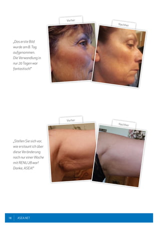 18 ASEA.NET
„Das erste Bild
wurde am 8.Tag
aufgenommen.
Die Verwandlung in
nur 20Tagen war
fantastisch!"
„Stellen Sie sich vor,
wie erstaunt ich über
diese Veränderung
nach nur einerWoche
mit RENU 28 war!
Danke, ASEA!"
Vorher
Nachher
Vorher
Nachher
 