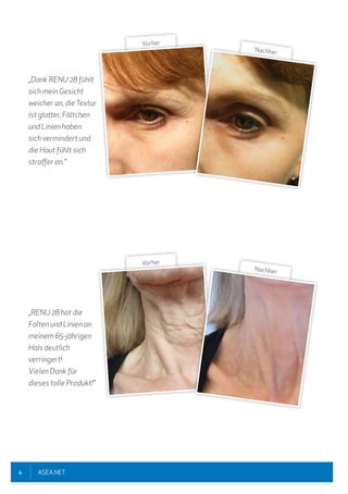 4 ASEA.NET
„Dank RENU 28 fühlt
sich mein Gesicht
weicher an, dieTextur
ist glatter, Fältchen
und Linien haben
sich vermindert und
die Haut fühlt sich
straffer an."
„RENU 28 hat die
Falten und Linien an
meinem 65-jährigen
Hals deutlich
verringert!
Vielen Dank für
dieses tolle Produkt!"
Vorher
Nachher
Vorher
Nachher
 