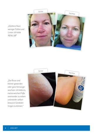 8 ASEA.NET
„Glattere Haut,
weniger Falten und
Linien. Ich liebe
RENU 28!"
„Die Risse sind
kleiner geworden
oder ganz herausge-
wachsen. Ich liebe es,
meine weichen Füße
aneinander zu reiben
und wieder selbst-
bewusst Sandalen
tragen zu können."
Vorher
Nachher
Vorher
Nachher
 