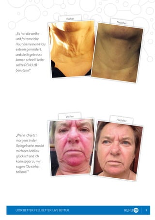9
LOOK BETTER. FEEL BETTER. LIVE BETTER.
„Es hat die welke
und faltenreiche
Haut an meinem Hals
extrem gemindert,
und die Ergebnisse
kamen schnell! Jeder
sollte RENU 28
benutzen!"
„Wenn ich jetzt
morgens in den
Spiegel sehe, macht
mich der Anblick
glücklich und ich
kann sogar zu mir
sagen: 'Du siehst
toll aus!'"
Vorher
Nachher
Vorher
Nachher
 