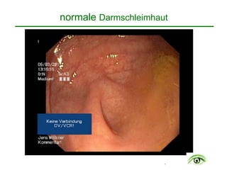 .
normale Darmschleimhaut
 