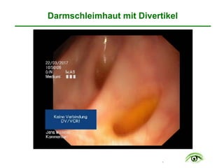 .
Darmschleimhaut mit Divertikel
 