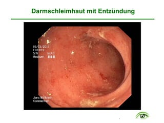 .
Darmschleimhaut mit Entzündung
 