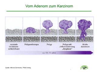 .
Vom Adenom zum Karzinom
Quelle: Hilfe bei Darmkrebs, TRIAS Verlag
 
