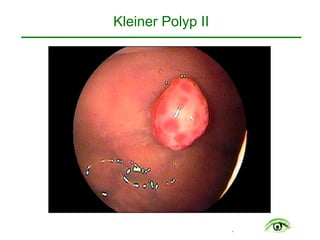 .
Kleiner Polyp II
 