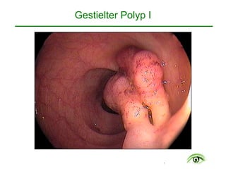 .
Gestielter Polyp I
 