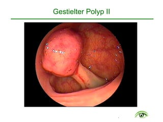 .
Gestielter Polyp II
 