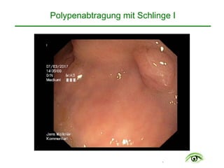 .
Polypenabtragung mit Schlinge I
 