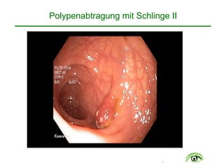 .
Polypenabtragung mit Schlinge II
 