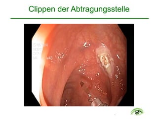 .
Clippen der Abtragungsstelle 
 