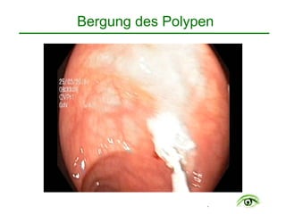 .
Bergung des Polypen
 