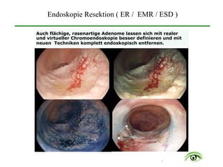 .
Auch flächige, rasenartige Adenome lassen sich mit realer
und virtueller Chromoendoskopie besser definieren und mit
neuen Techniken komplett endoskopisch entfernen.
Endoskopie Resektion ( ER / EMR / ESD )
 