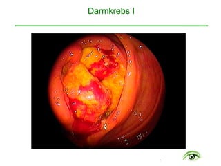 .
Darmkrebs I
 