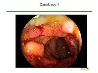 .
Darmkrebs II 
 