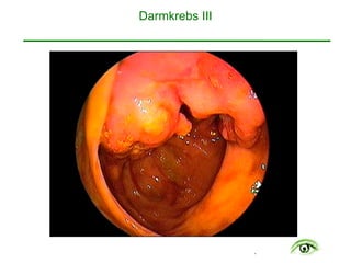 .
Darmkrebs III 
 