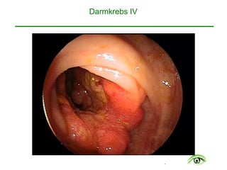 .
Darmkrebs IV 
 