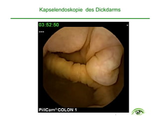 .
Kapselendoskopie des Dickdarms
 