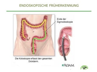 .
ENDOSKOPISCHE FRÜHERKENNUNG
 