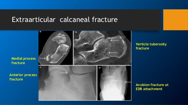 Calcaneum fracture- pathoanatomy & various fracture pattern