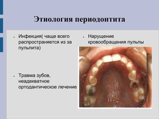 Этиология периодонтита
● Инфекция( чаще всего
распространяется из за
пульпита)
● Травма зубов,
неадекватное
ортодантическое лечение
● Нарущение
кровообращения пульпы
 
