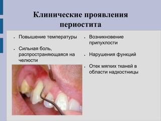 Клинические проявления
периостита
● Повышение температуры
● Сильная боль,
распространяющаяся на
челюсти
● Возникновение
припухлости
● Нарушения функций
● Отек мягких тканей в
области надкостницы
 