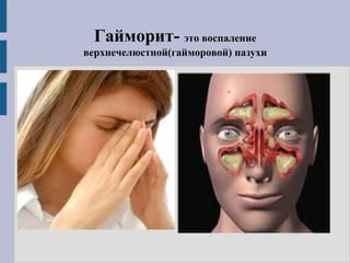 Гайморит- это воспаление
верхнечелюстной(гайморовой) пазухи
 