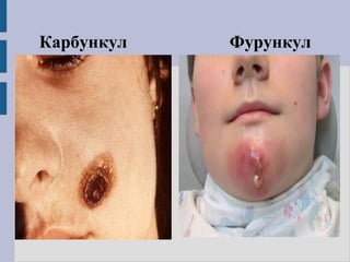 Карбункул Фурункул
 