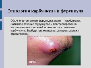 Этиология карбункула и фурункула
● Обычно встречаются фурункулы, реже — карбункулы.
Затяжное течение фурункулов и прогрессирование
воспалительных явлений может вести к развитию
карбункула. Возбудителями являются стрептококки и
стафилококки.
 