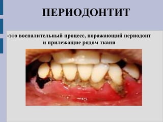 ПЕРИОДОНТИТ
-это воспалительный процесс, поражающий периодонт
и прилежащие рядом ткани
 