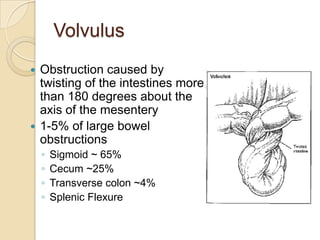 Volvulus
 Obstruction caused by
  twisting of the intestines more
  than 180 degrees about the
  axis of the mesentery
 ...