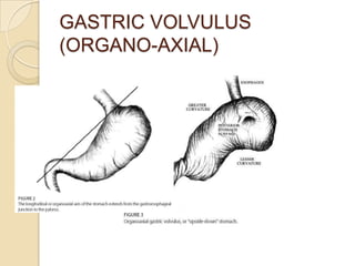 GASTRIC VOLVULUS
(ORGANO-AXIAL)
 