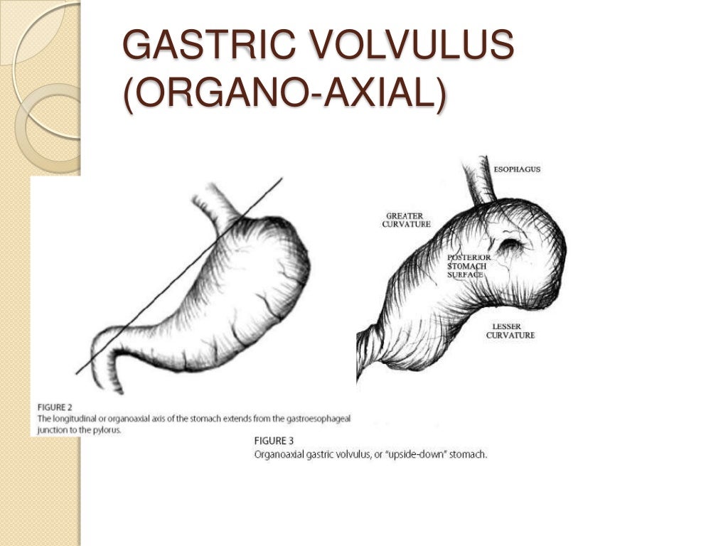 Volvulus