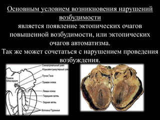 Основным условием возникновения нарушений
возбудимости
является появление эктопических очагов
повышенной возбудимости, или эктопических
очагов автоматизма.
Так же может сочетаться с нарушением проведения
возбуждения.
 