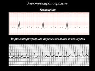 Тахикардия
Электрокардиограммы
Атриовентрикулярная пароксизмальная тахикардия
 