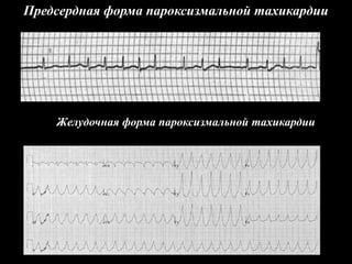 Предсердная форма пароксизмальной тахикардии
Желудочная форма пароксизмальной тахикардии
 
