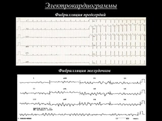 Электрокардиограммы
Фибрилляция предсердий
Фибрилляция желудочков
 