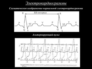 Электрокардиограммы
Схематическое изображение нормальной электрокардиограммы
Альтернирующий пульс
 