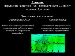 Аритмии
нарушение частоты и (или) периодичности СС носит
название Аритмии.
Этиологические причины:
Функциональные Органические
Имеют психогенное, рефлекторное
происхождение либо следствием
гипоксии и электролитных
расстройств.
Наблюдаются при органических
поражениях миокарда (инфаркте,
воспалении, кардиосклерозе)
 