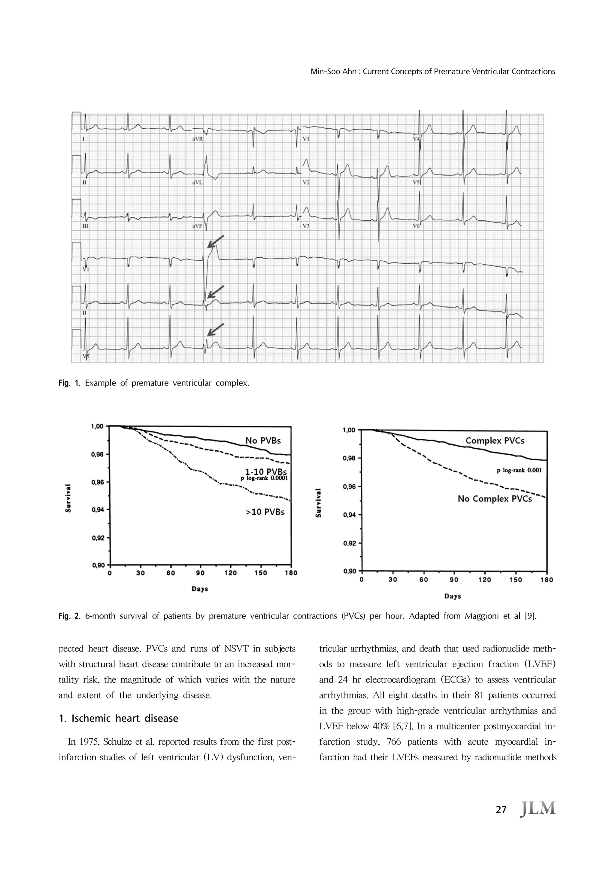 27
Min-Soo Ahn : Current Concepts of Premature Ventricular Contractions
Fig. 1. Example of premature ventricular complex.
Fig. 2. 6-month survival of patients by premature ventricular contractions (PVCs) per hour. Adapted from Maggioni et al [9].
pected heart disease. PVCs and runs of NSVT in subjects
with structural heart disease contribute to an increased mor-
tality risk, the magnitude of which varies with the nature
and extent of the underlying disease.
1. Ischemic heart disease
In 1975, Schulze et al. reported results from the first post-
infarction studies of left ventricular (LV) dysfunction, ven-
tricular arrhythmias, and death that used radionuclide meth-
ods to measure left ventricular ejection fraction (LVEF)
and 24 hr electrocardiogram (ECGs) to assess ventricular
arrhythmias. All eight deaths in their 81 patients occurred
in the group with high-grade ventricular arrhythmias and
LVEF below 40% [6,7]. In a multicenter postmyocardial in-
farction study, 766 patients with acute myocardial in-
farction had their LVEFs measured by radionuclide methods
 