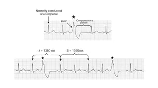 Comprehensive ECG Analysis and Management of Ventricular Premature ...