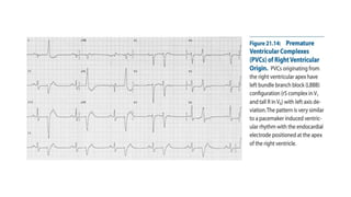 Comprehensive ECG Analysis and Management of Ventricular Premature ...