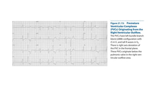 Comprehensive ECG Analysis and Management of Ventricular Premature ...